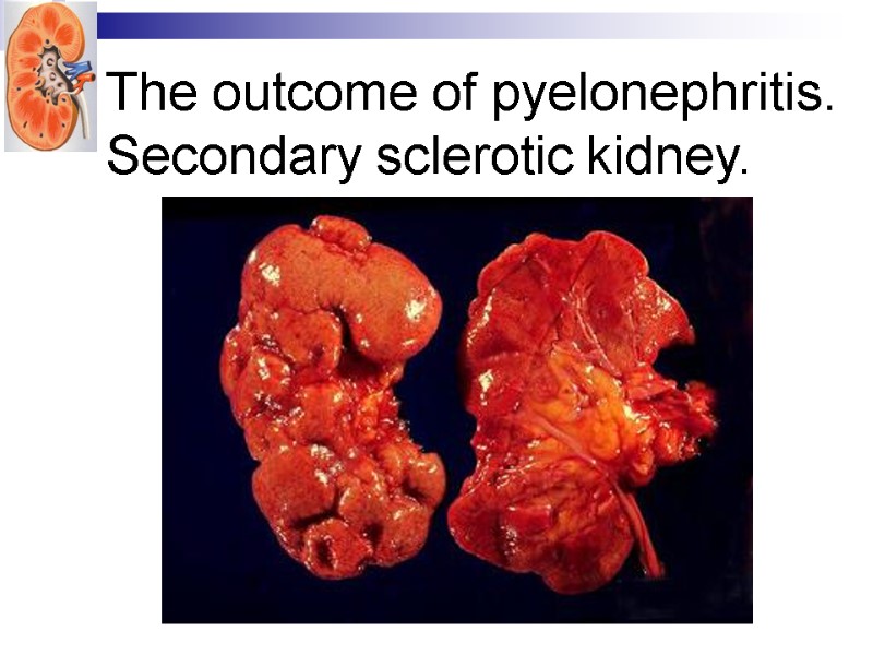 The outcome of pyelonephritis. Secondary sclerotic kidney.